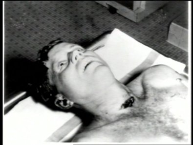 JFK neck wound
